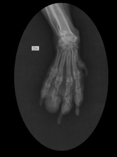 10 distal do 4º dedo direito e aumento de volume de tecidos moles em correspondência ao coxim digital do 4º dedo direito e adjacências (Figura 3).