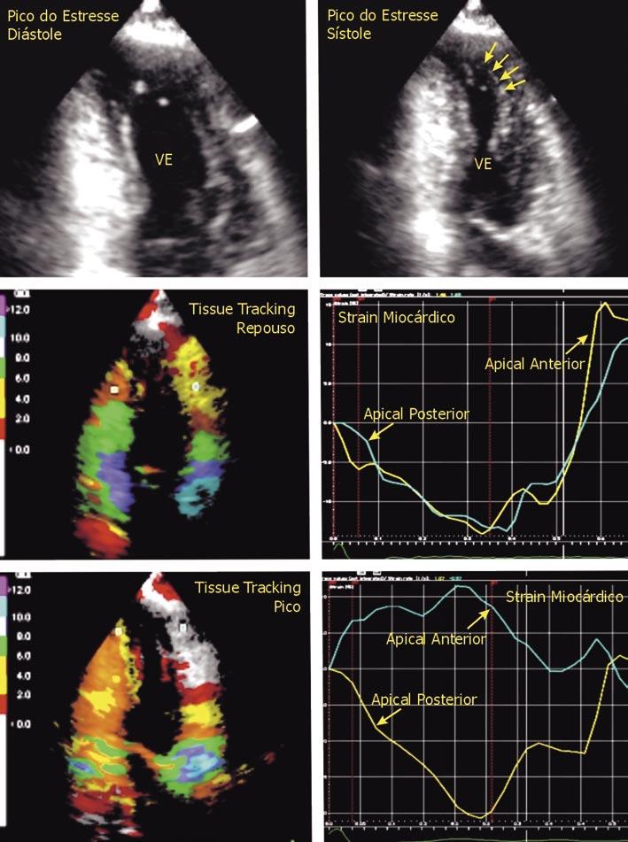 Figura 7: A: Apical de 2 câmaras, em diástole, no pico do esforço; B: mesmo corte, em sístole, mostrando acinesia apical anterior (setas); C: tissue tracking durante o repouso, mostrando deslocamento