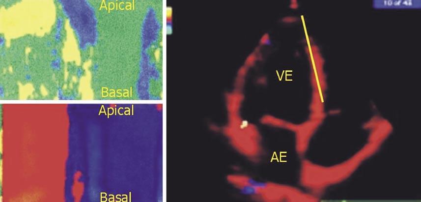 também na detecção de miocárdio viável 43-46. Hoffmann et al.