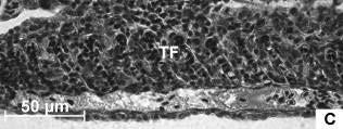 Observar proliferação de células entre lamelas (X), inclusive a fusão completa de todas as lamelas secundárias