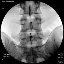 INFERIORES ARTICULAÇÕES INTERVERTEBRAIS