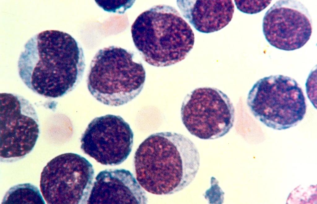 LEUCEMIA LINFOBLÁSTICA AGUDA (LLA) VARIANTE LLA- EM HOMEM COM 4 ANOS. LEUCÓCITOS: 5.