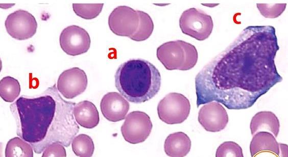 INFECÇÃO POR CITOMEGALOVIRUS (VIRUS DA HERPES) LEUCÓCITOS:.