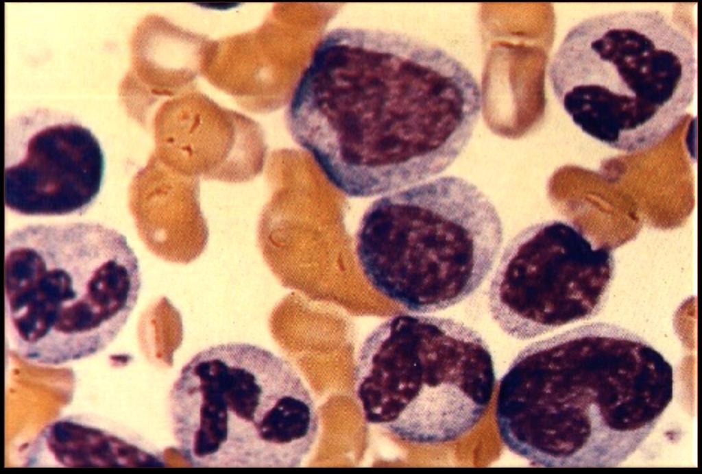 6 7 5 5 4 LEUCEMIA MIELÓIDE CRÔNICA. Hb: 0, g/dl, VCM: 0 fl, HCM: 8 pg, LEUCÓCITOS: 587.000/mm.