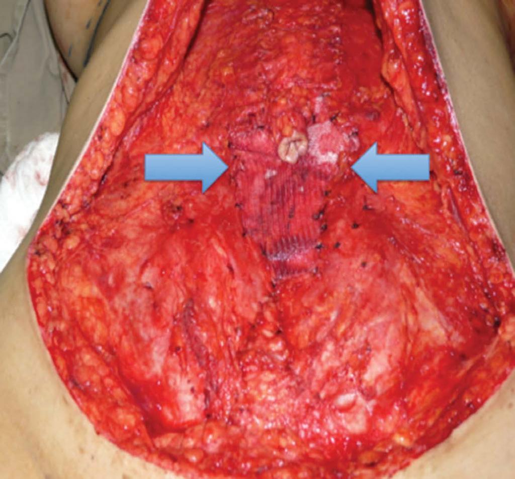 Primeira tela de polipropileno, delimitado pelas setas, suturada às bordas do defeito aponeurótico de TRAM bipediculado.