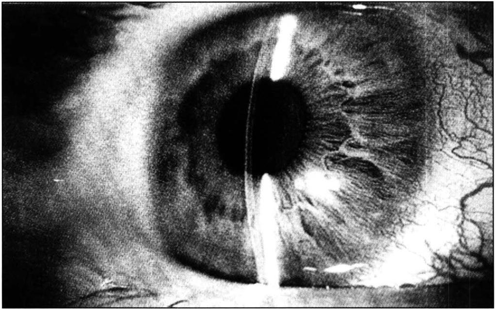 Biomicroscopia ultrasônica do segmento anterior de olhos com seio camerula r passível de oclusão de elucidar o papel das estruturas oculares durante o bloqueio pupil ar 5.