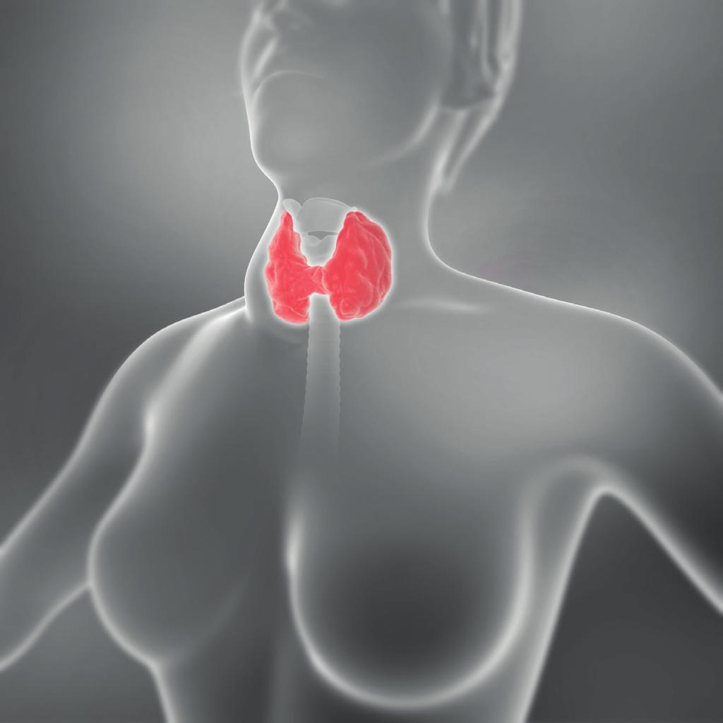 TIREOIDECTOMIA A tireoidectomia é a remoção da glândula tireoide, que pode ser total ou parcial.