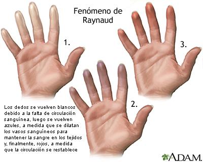 FIGURA 1: Manifestações clínicas do Fenômeno de Raynaud. FONTE: Fenómeno de Raynaud, 2016. O paciente costuma queixar-se de formigamentos, queimação e amortecimento na área afetada.