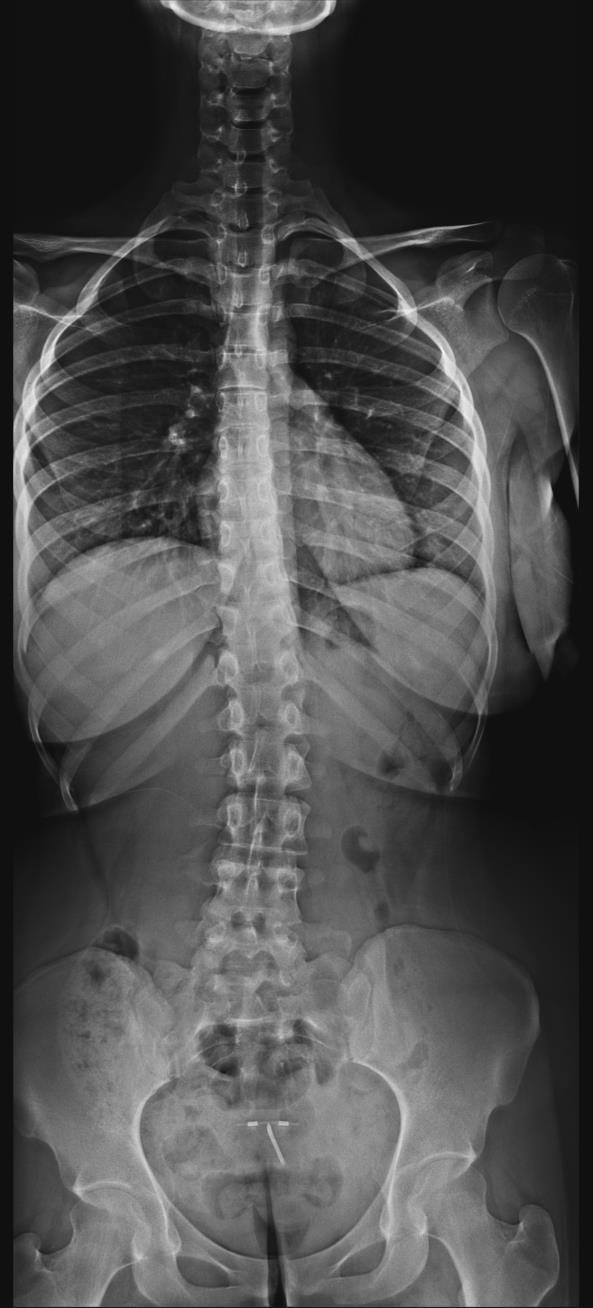 Escoliose Radiografia panorâmica da coluna vertebral em ortostase Curvas de até 30