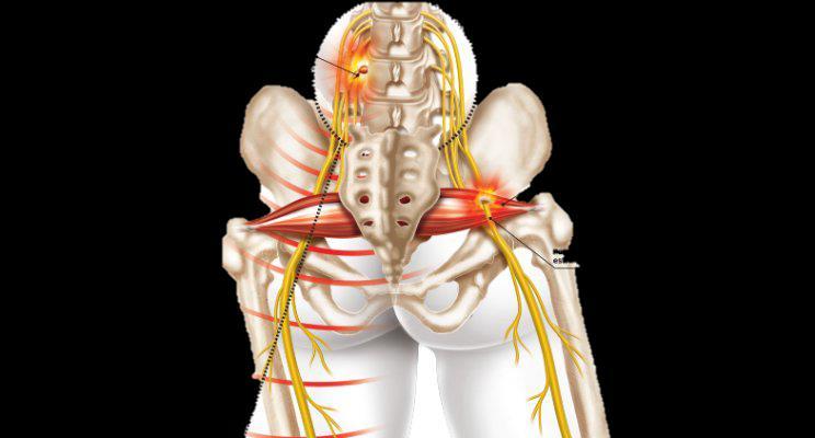 LOMBOCIATALGIA O nervo ciático e