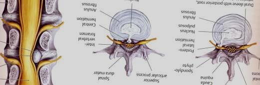 dural, medula ou raízes nervosas.