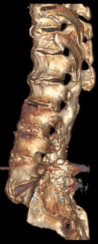 e calcificações #