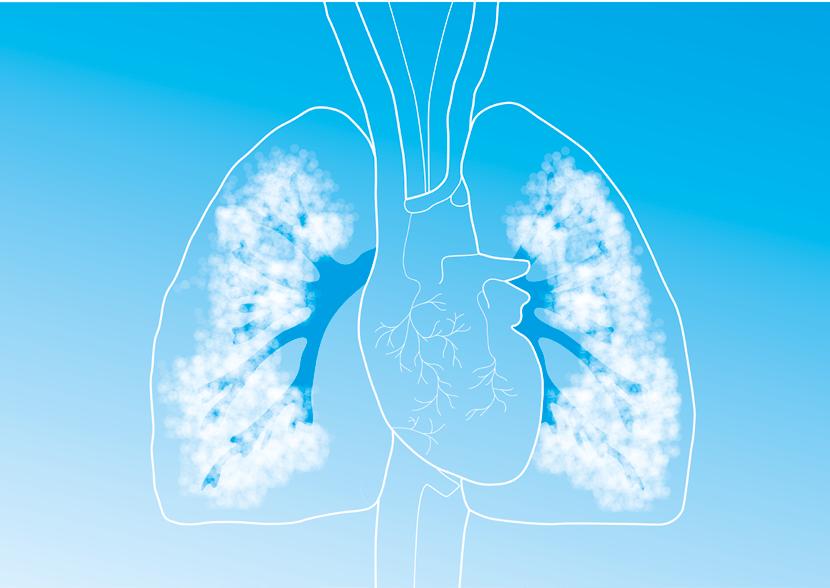 O óxido nítrico como Vasodilatador Pulmonar Seletivo Monitoramento eficaz O óxido nítrico (NO), na sua forma inalatória, é um gás que promove a vasodilatação pulmonar seletiva, promovendo o