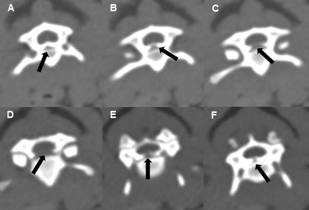 27 Figura 2 Mielotomografia do segmento C3-C4 (A a F, imagens dos cortes entre C3 e C4) evidenciando falha na continuidade do contraste (setas pretas) no canal vertebral entre as vértebras C3 e C4 de