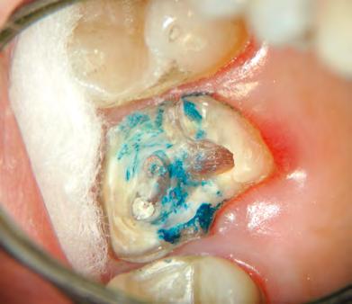 cirurgia de acesso em um molar inferior ().