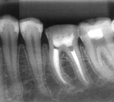 médio do primeiro molar inferior submetido a um tratamento endodôntico ().