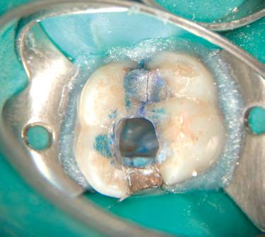 tratamento endodôntico com grande perda de estrutura dentinária (C).