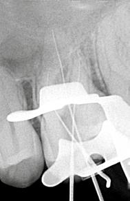 (Helse Dental Technology) sendo usada no