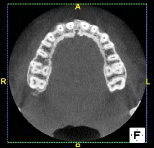 ENDODONTI D E V N G U R D Não podemos deixar de mencionar que um dos fatores limitantes da radiografia periapical é o de produzirem imagens bidimensionais de uma anatomia tridimensional.