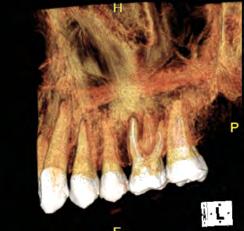 de reconstrução tridimensional do dente a ser tratado nos facilita a visualização precisa da anatomia interna da câmara