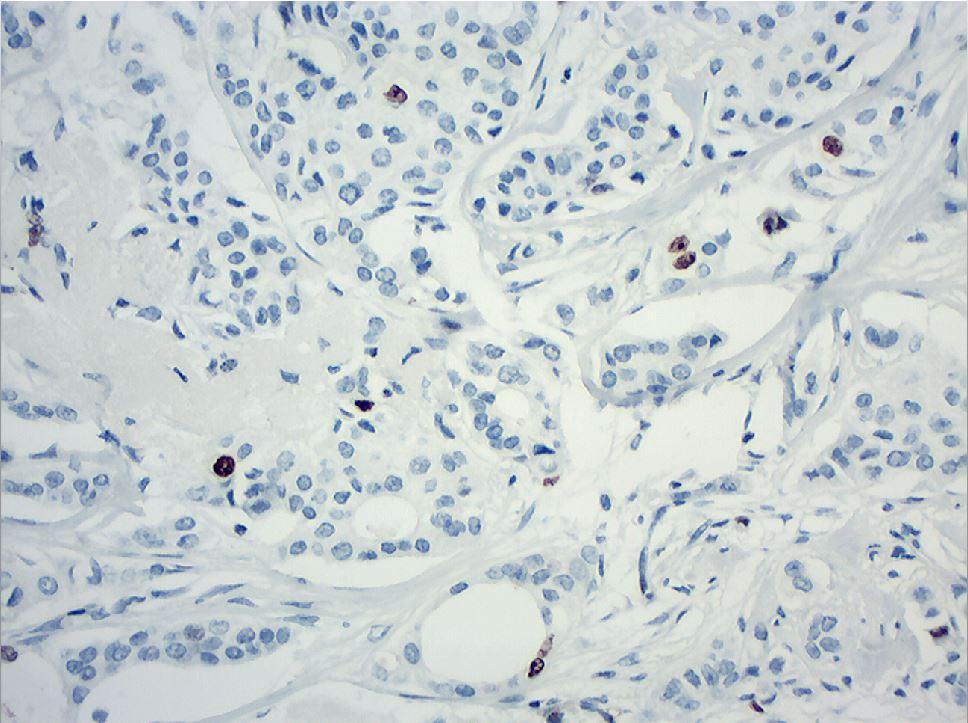 Pacientes e Métodos Figura 24 Neoplasia com baixa atividade proliferativa mostrando marcação