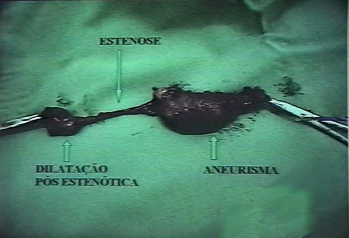 [30] (Figuras 4 e 5). Figura 4 Estenose de FAV (1 o Congresso Brasileiro Multidisciplinar de Acesso Vascular para Hemodiálise.