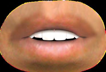 utoli ado com Excelência g p r o t o c o l o c l í n i c o lguns estudos 50-51 mostram que o tratamento ortodôntico altera desfavoravelmente o arco do sorriso em 1/3 dos casos.