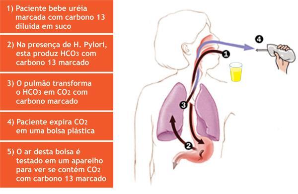 Helicobacter pylori Bacilo Gram negativo curvado em espiral, móvel e produtor de urease (sobreviência na acidez gástrica) Condições de crescimento: microaerofilia Distribuição mundial: países em