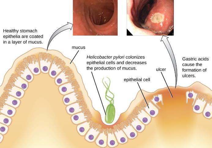 Helicobacter pylori Bactéria se acopla às células secretoras de muco da mucosa gástrica; Urease: produz amônia (neutraliza