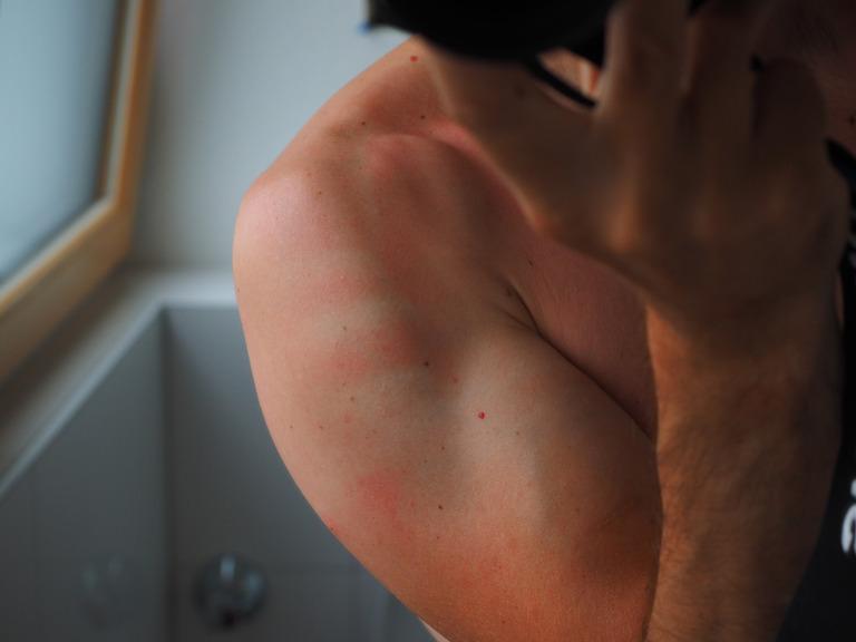 MANCHAS A (d)epilação com cera quente pode manchar ou escurecer a pele? Manchas escuras podem aparecer por conta da exposição solar ou da luz do próprio ambiente.