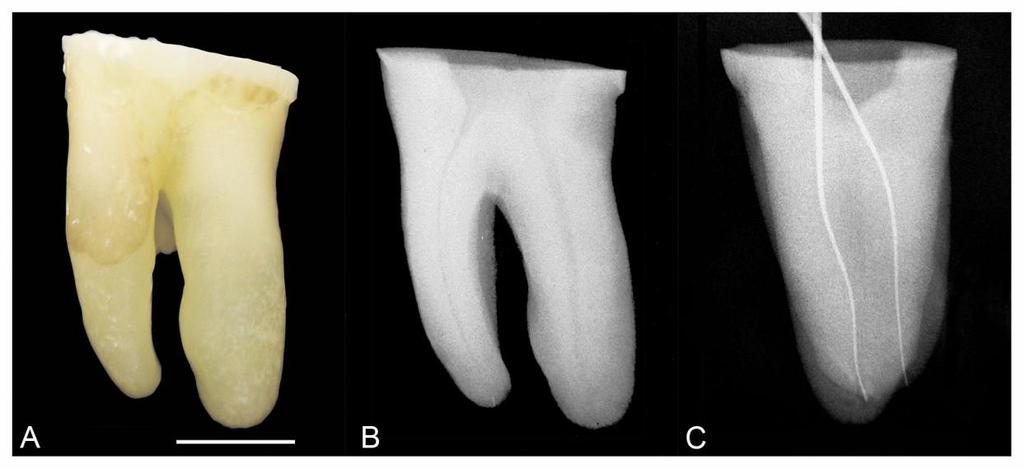 - 46 - Material e Métodos restante do teto da câmara pulpar foi removido com auxílio de Endo-Z (Dentsply Maillefer, Baillagues, Suiça) em alta rotação, sob refrigeração.