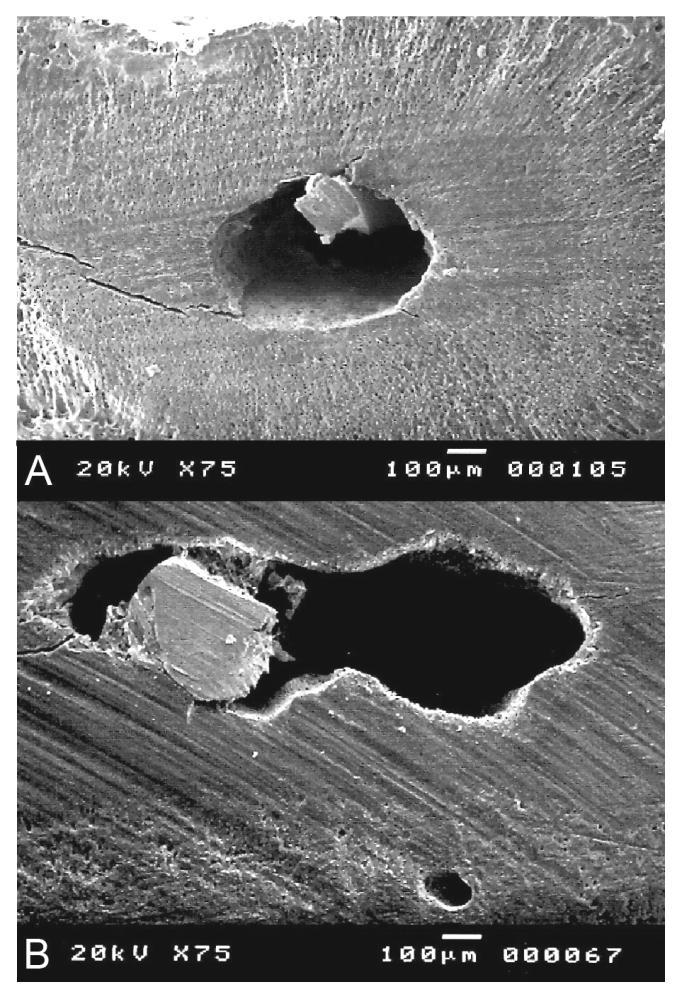 Resultados - 65 - Figura 10. Fotomicrografias da região apical dos canais mésio-lingual (A) e distal (B) a 1mm do ápice mostrando a ocupação do IAI. 3.