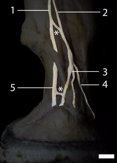 dorsal; 4) Ramo do nervo digital palmar medial; 5)Nervo digital palmar medial; 6) Bifurcação do Ramo dorsal; *) Ramos