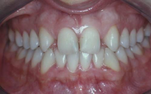 15 3 - RELATO DE UM CASO CLÍNICO Paciente ACD, gênero feminino, 23 anos e 4 meses de idade procurou o atendimento na Clínica de Ortodontia da Faculdade de Odontologia de Araçatuba-UNESP, tendo como