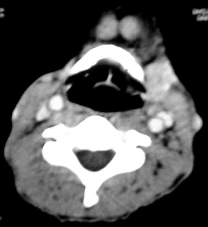 diferente de A). 5.12 Cadeia Linfonodal Submandibular Tabela 13.