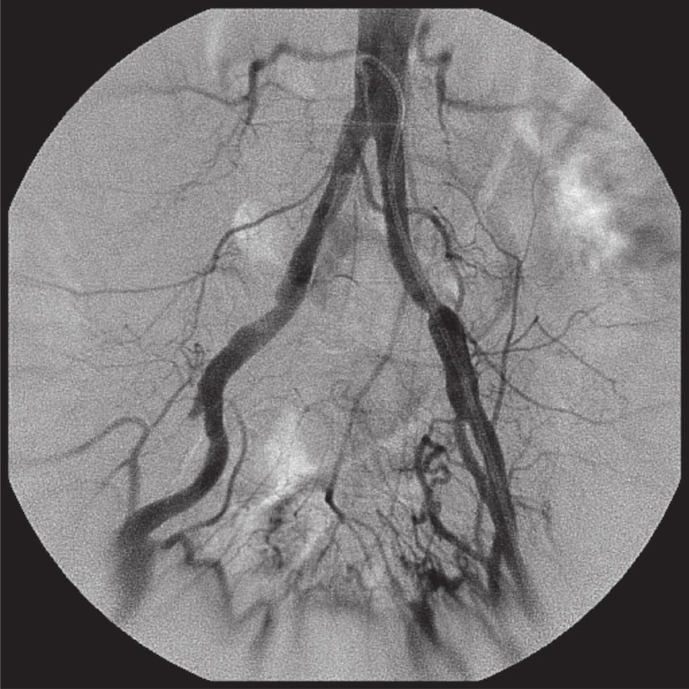 Tratamento endovascular de oclusões arteriais crônicas - Neves D Q et al. J Vasc Bras 2012, Vol.