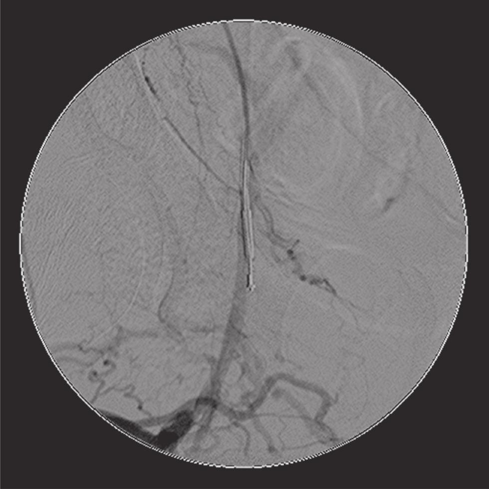 Tratamento endovascular de oclusões arteriais crônicas - Neves D Q et al. J Vasc Bras 2012, Vol. 11, Nº 3 229 Figura 6. Cateter Outback subintimal. Figura 8.