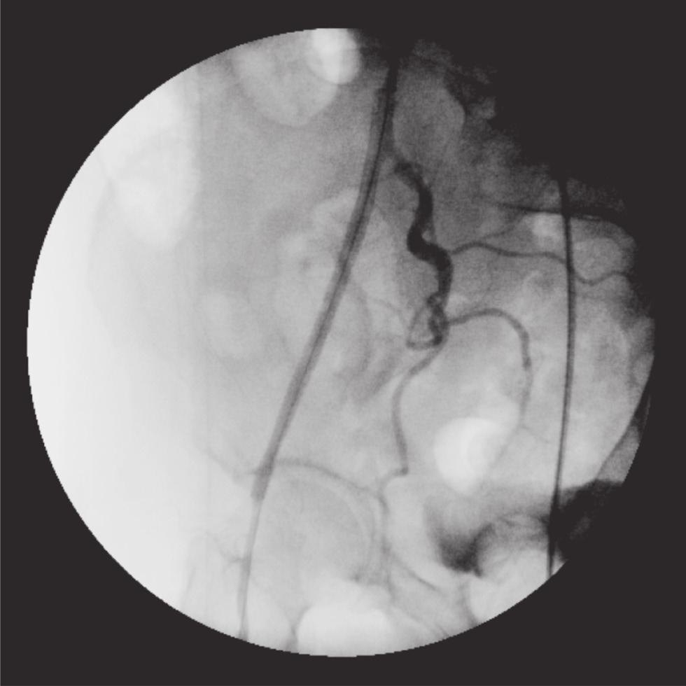 230 J Vasc Bras 2012, Vol. 11, Nº 3 Tratamento endovascular de oclusões arteriais crônicas - Neves D Q et al.