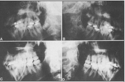 39 Figura 15 - Radiografias cefalométricas em 60 graus no lado direito (B e D) e esquerdo (A e C) aos 13 anos de idade (AeB), antes da extração do2mi, e na idade de 18 (C e D), com os terceiros