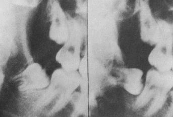 42 Figura 19 - Mudança na angulação do 3MI, de mesio-angular para horizontal, entre 18-21 anos. Fonte: Richardson, 1998, p. 5.