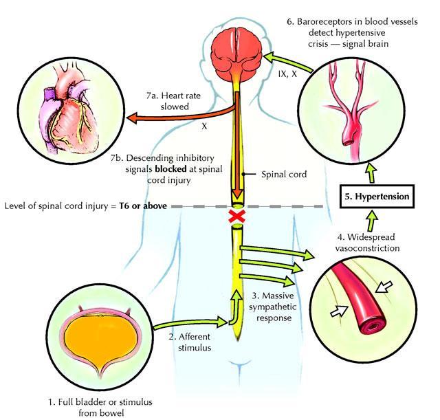 Disreflexia Autonômica lesões medulares T6 ou acima O controle de centros superiores sob neurônios simpáticos é interrompido abaixo da lesão.