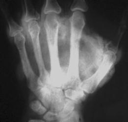 Portuguese Journal of Orthopaedics and Traumatology 57 Figura 2: Raio-X da mão evidenciando a acumulação de produto de contraste radiográfico no espaço extravascular.