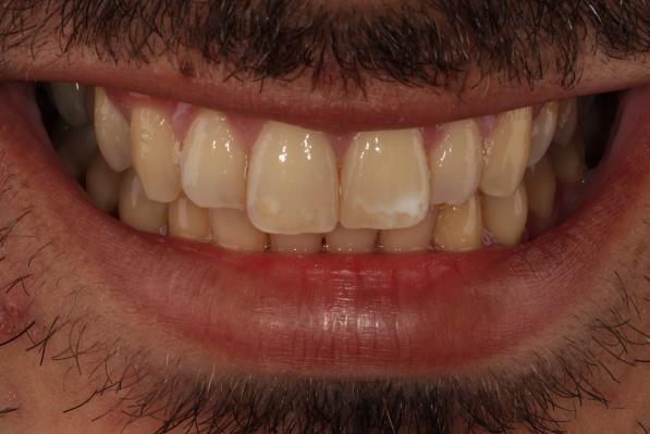 Durante exame clínico foram detectadas manchas brancas nos dentes 11 e 21, sendo diagnosticadas como hipoplasia de esmalte (Figura 1a e 1b).