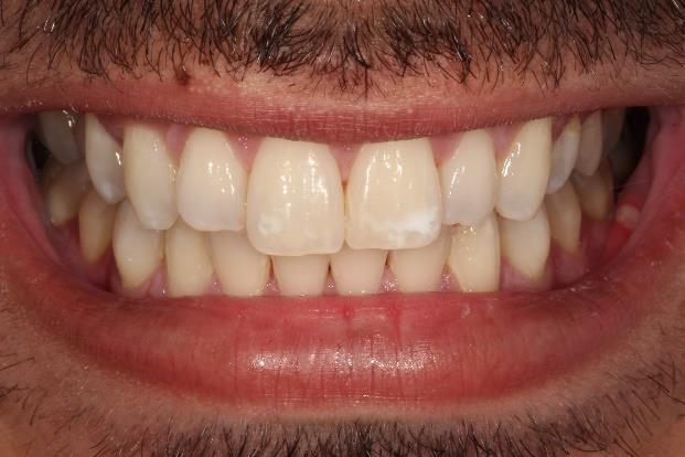 15 O primeiro tratamento a ser realizado foi o clareamento dental em consultório com o peróxido de hidrogênio a 35% (Whiteness HP AutoMixx (FGM Produtos Odontológicos, Joinville-SC, Brasil).