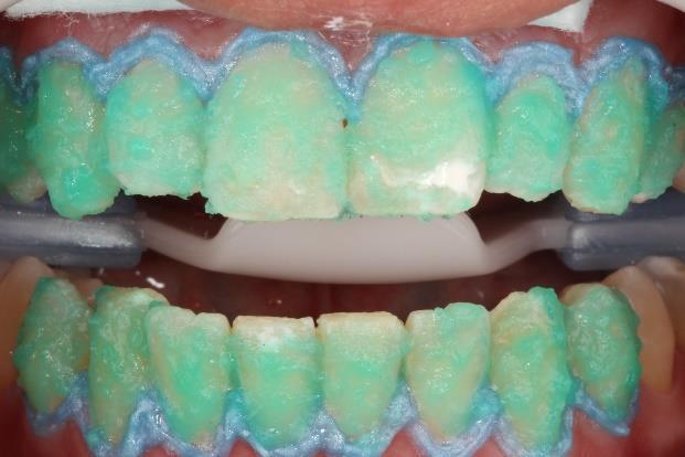 Brasil) aplicada no contorno gengival entre pré-molares, com intuito de evitar qualquer irritação ou injúria à mucosa (Figura 3).