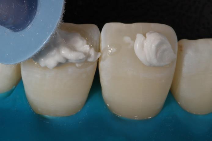 (Figura 7), promovendo assim o desgaste da camada superficial do esmalte dentário. Depois do condicionamento ácido, a área foi lavada durante 30 segundos com água em abundância e seca logo em seguida.