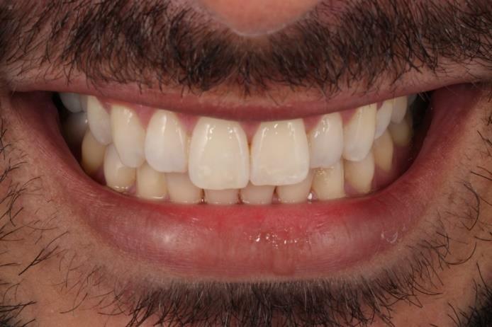 19 Após a finalização do tratamento pode-se observar a melhora na coloração das opacidades brancas em ambos os dentes anteriores superiores trazendo benefícios, e