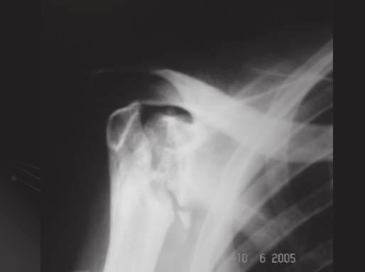 Figura 1 Masculino, 54 anos, quatro anos de pós-operatório, ombro direito Figura 2 Radiografia pós-operatória do paciente da figura 1.