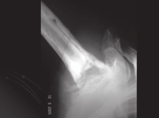 Para Levy (7), a artroplastia de ressecção é procedimento padrão no tratamento das infecções em prótese de ombro.