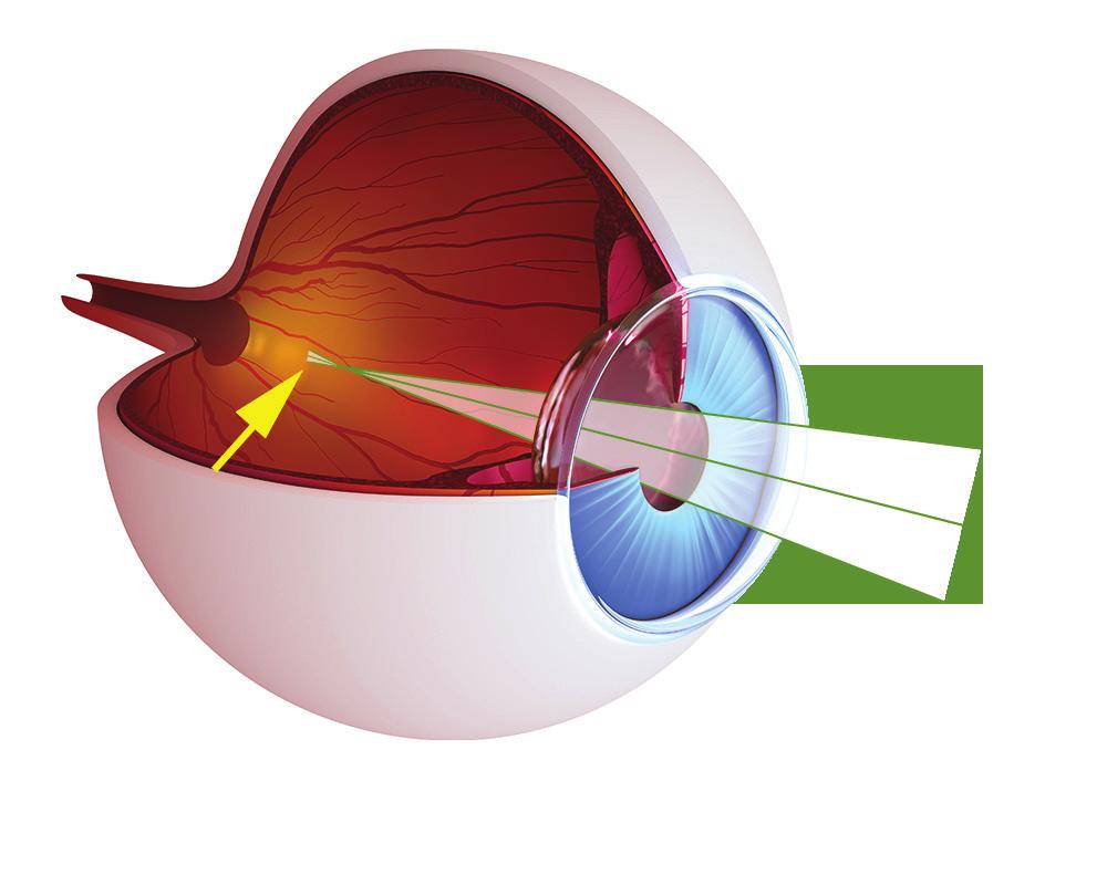 Miopia A palavra miopia vem do grego "olho fechado", porque as pessoas com esta condição, freqüentemente apertam os olhos para ver melhor à distância.